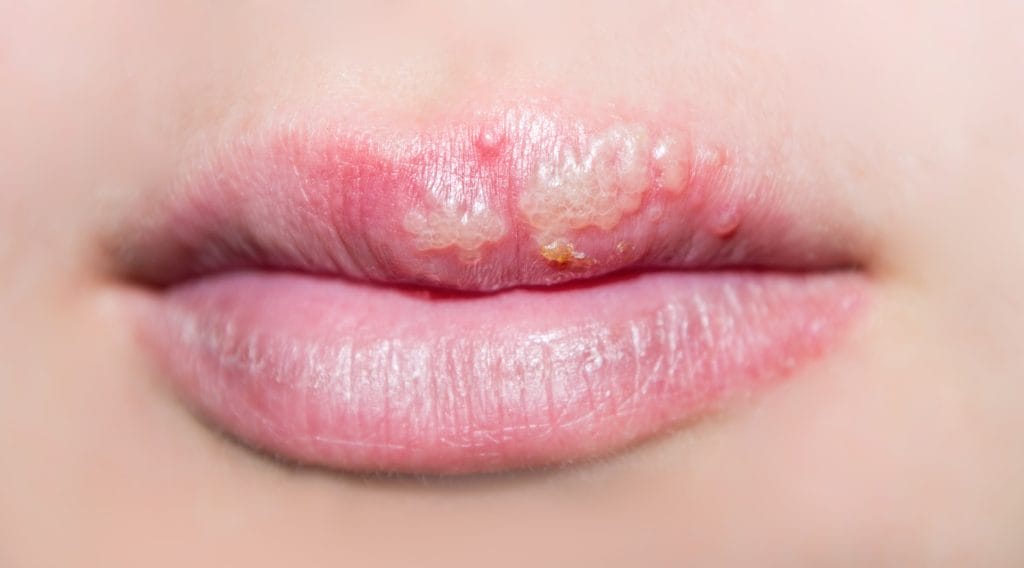 Cold sores