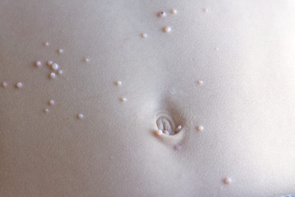 Molluscum Contagiosum