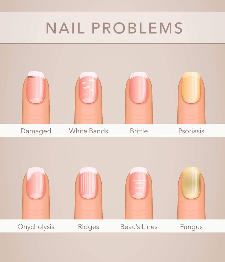 Nail Disorders