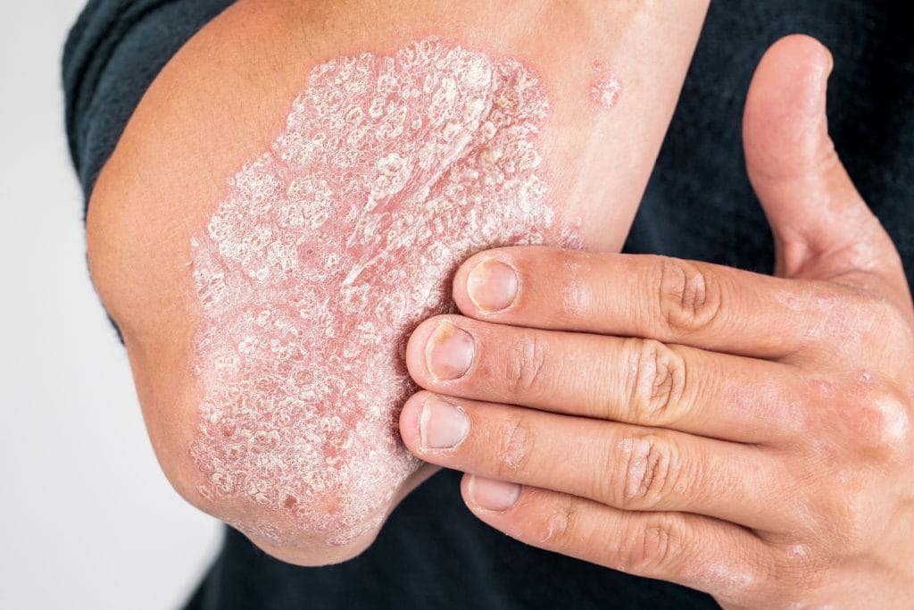 psoriasis plaque on arm