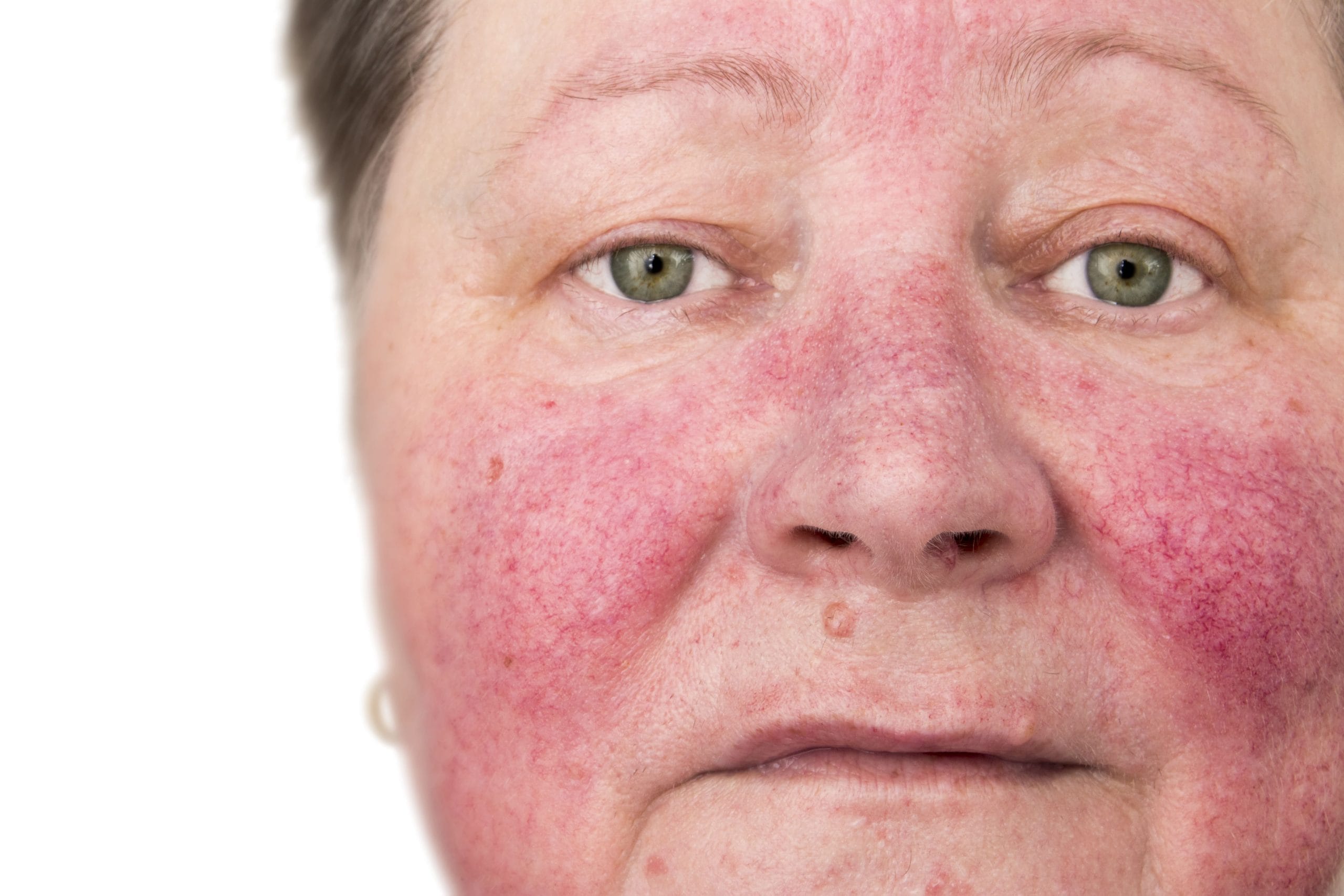 Rosacea