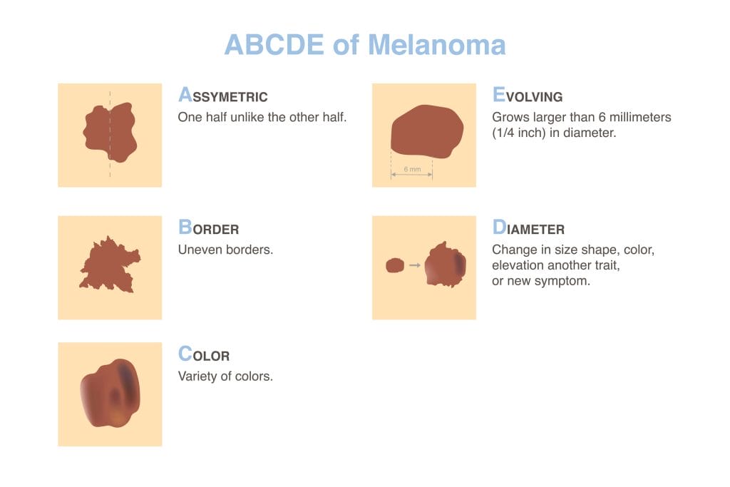abcdes of melanoma