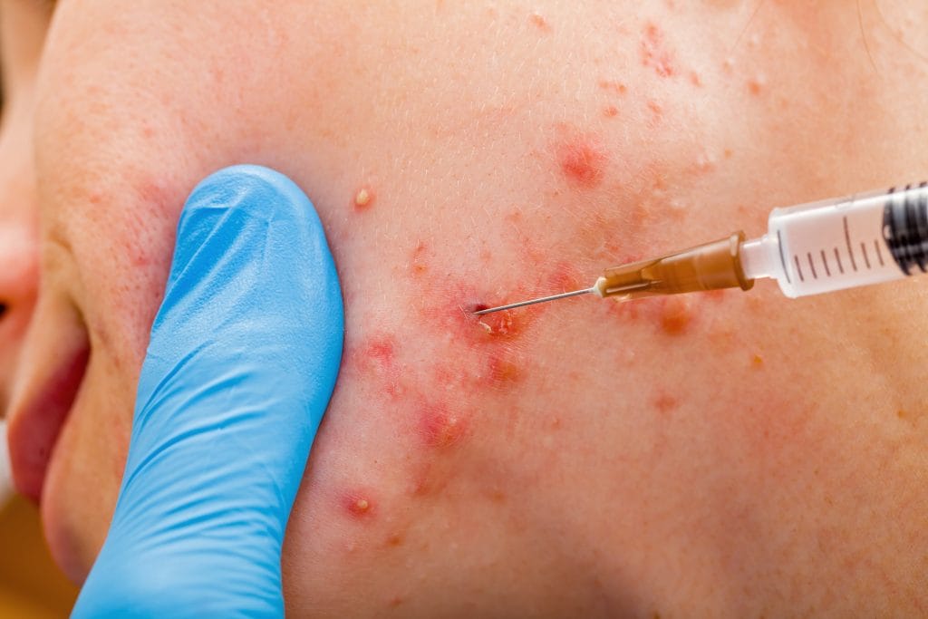 Acne injections