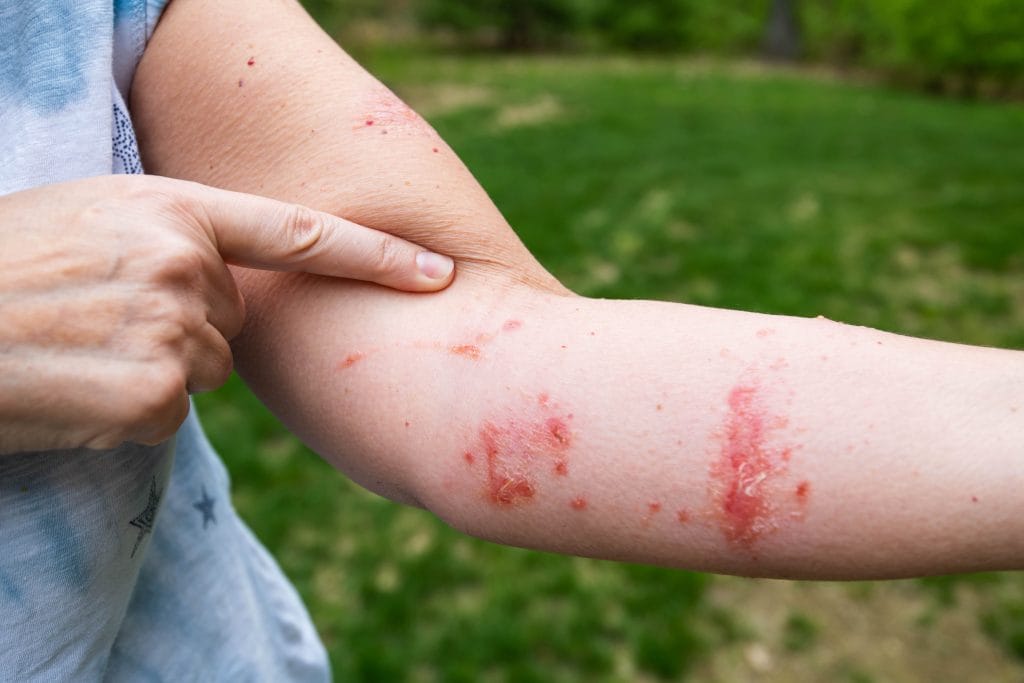 allergic rash contact dermatits