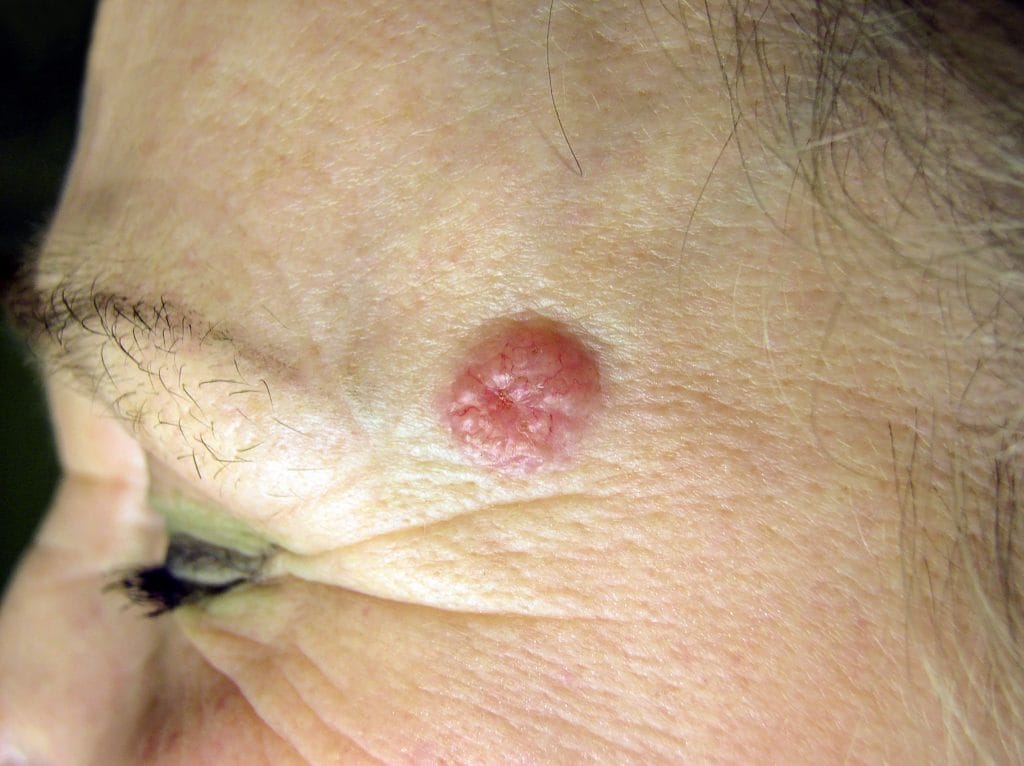 basal cell carcinoma