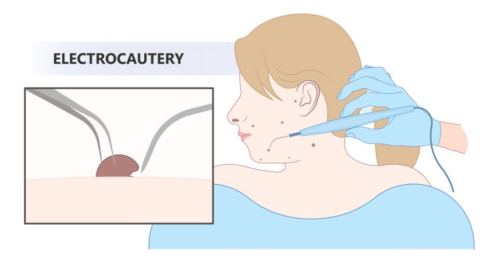 Electrocautery