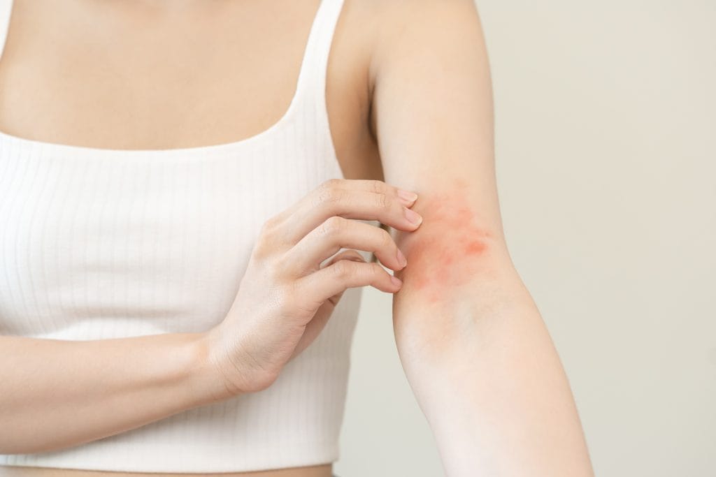 eczema rash on womans arm