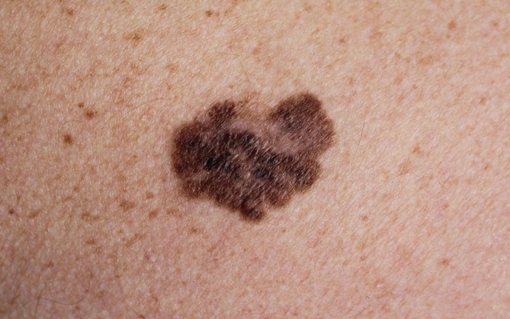 melanoma skin cancer