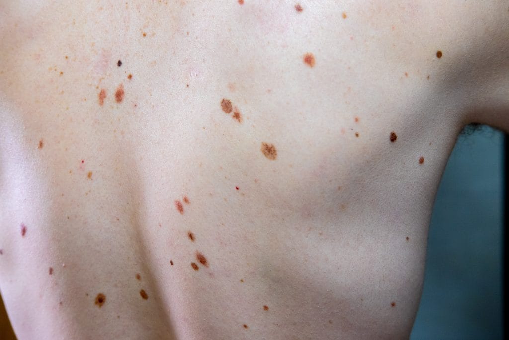 moles on a persons back 