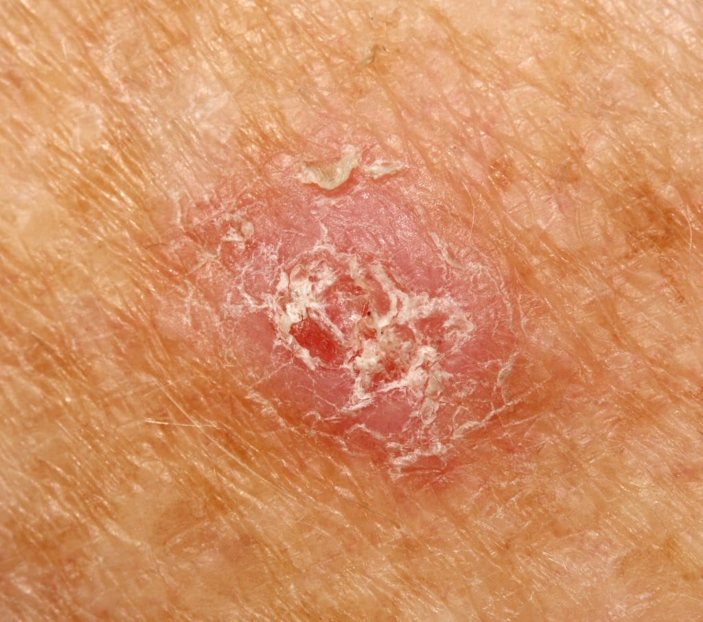 Squamous Cell Carcinoma 