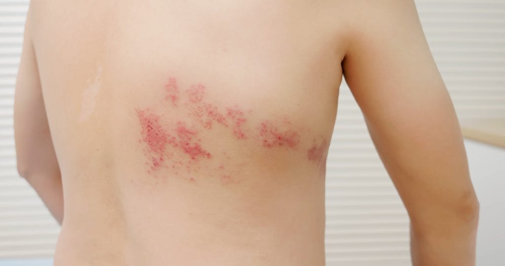 shingles