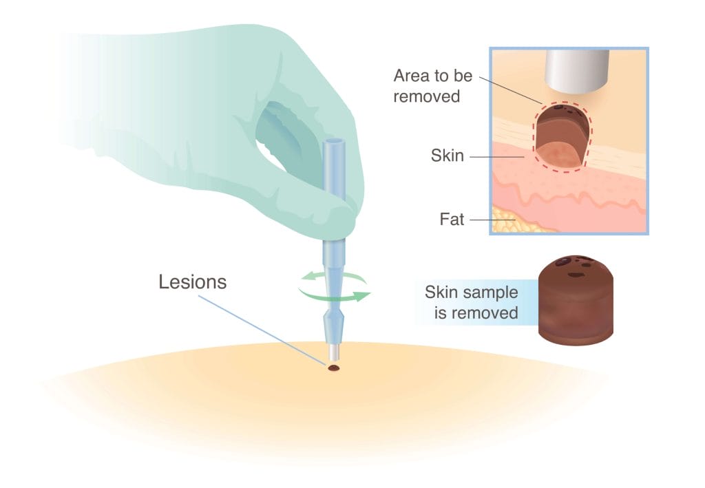 Skin Biopsy