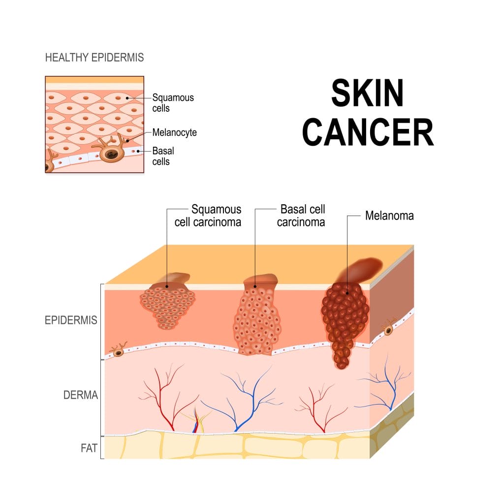 types of skin cancer