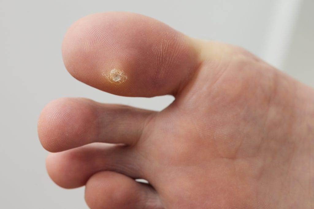 Wart on a toe